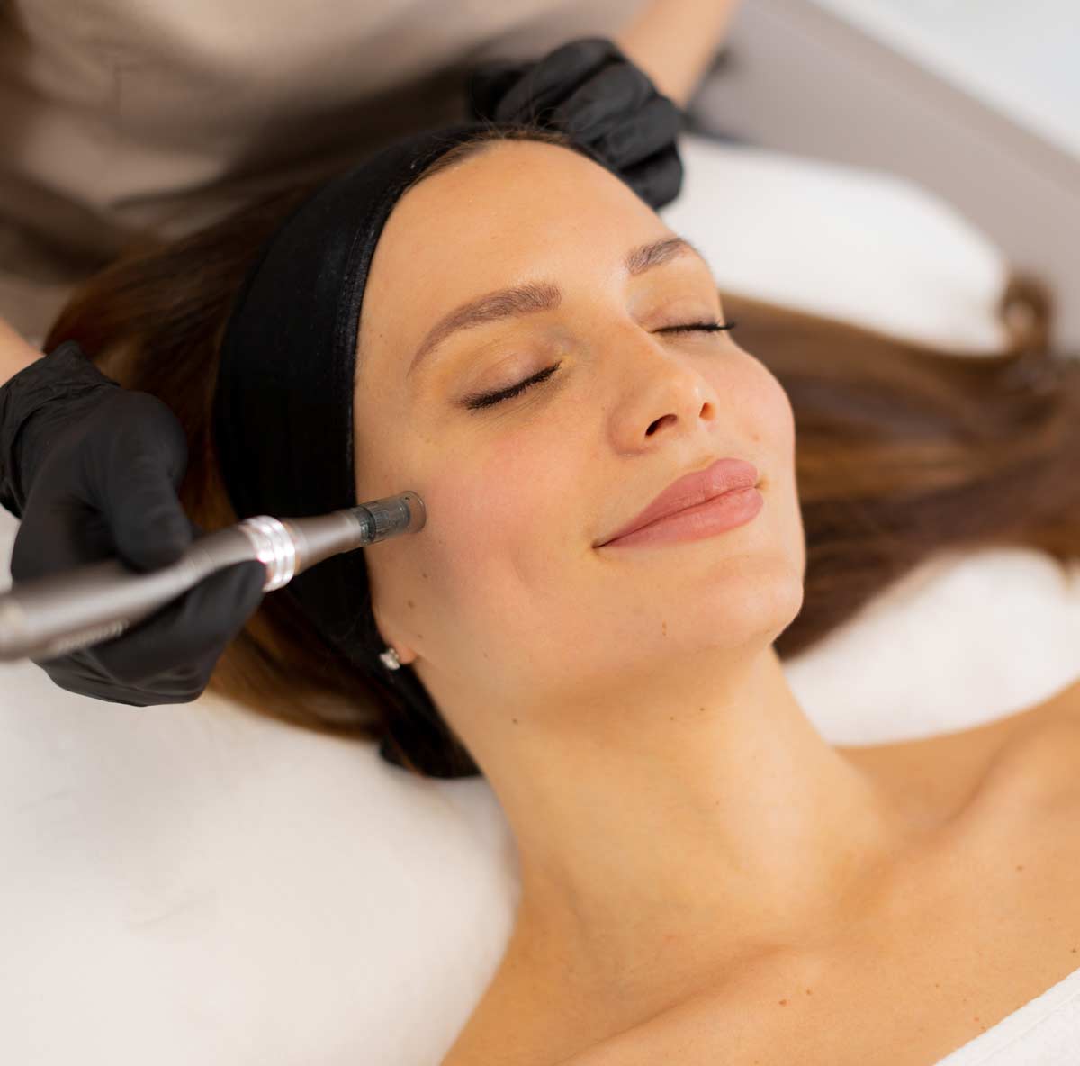 beautiful-woman-recieving-microneedling-treatment